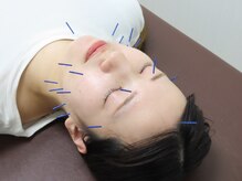 そよな はり灸整骨院/美容鍼