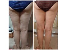 セル脂肪もお任せ！お悩みの方はご相談ください★