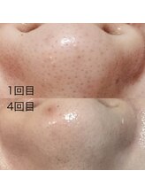 マテリアル(Material`)/REVIハーブピーリング