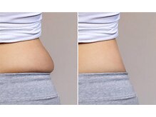 ナチュレアンドメディカ(Nature&Medica)/オンダ痩身4箇所以降1箇所¥8,000