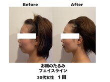 ラナン パラフューズ(Ranun's PARAFUSE.)/横顔美人に♪更に目も大きく♪