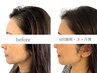 【ヘアラインや薄い部分に】育毛促進ピストル  一回27,000円→
