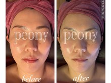 ピオニー(PEONY)/特許取得手技 小顔 &nbsp;