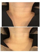 カシェート(cachette)/ララピール/シワ対策