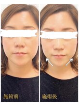 鍼とよもぎ。/美容鍼/ビフォーアフター