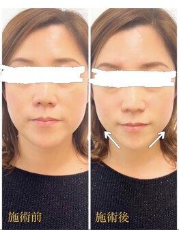 鍼とよもぎ。/美容鍼/ビフォーアフター