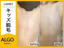 アルゴ 福井店(ALGO)/キッズ背中脱毛 10回目