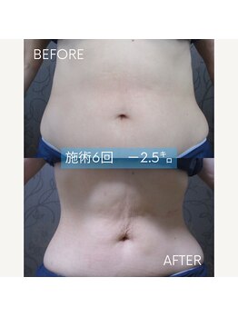 ヴィオテラス(VIOTERACE)/上半身ダイエット☆★