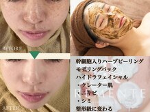 リメンテ 池袋東口店(REMENTE)の雰囲気（ハイドラフェイシャルやホワイトニングなど同時に施術も可能です）