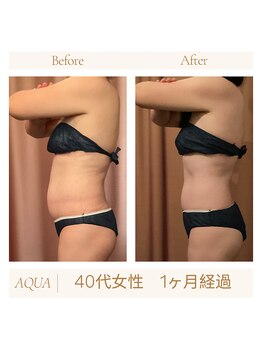 アクア(AQUA)/ハイパーナイフ痩身☆