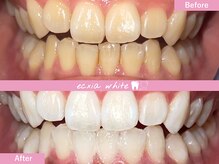 エクシアホワイトニング 札幌中島公園店/Before After［ホワイトニング］