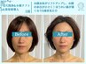 満足度No1【フェイシャル全ケア】ハイドラ毛穴洗浄×小顔リフト×美容液導入