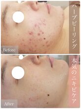 リアンビューティー(Lien Beauty) ハーブ ピーリング