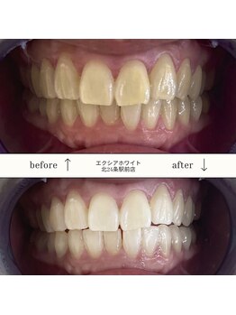 エクシアホワイト 平岸駅前店/ホワイトニングビフォーアフター