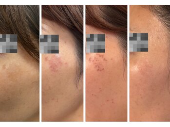 ヘルシーアンドビューティー でわ/シミ改善