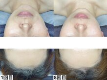 アンドミー 大阪梅田店(&me)/ララピール【艶/美白/くすみ】