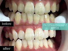 ホワイトニングカフェ 博多駅前店(WhiteningCafe)/◎歯のホワイトニング施術写真◎