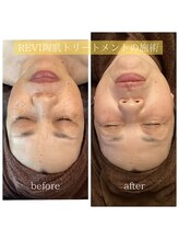ソーレ(Sole)/REVIの陶肌トリートメント