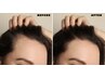 【当日実感】幹細胞毛髪再生プログラム☆期間限定85％OFF　27,500円→