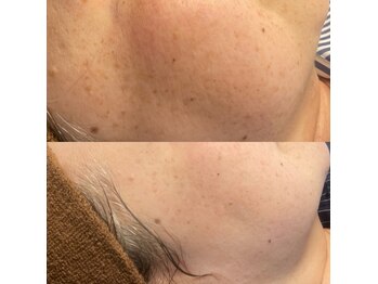 モルセラ(Moluccella)/3回の施術