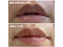 ジュエカフネ 広尾(JueCAFUNe)/《ルメラ》唇メラニンケア