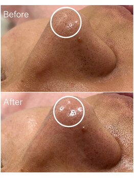 ジョアアンジェ 京橋店(joie ange)/黒ずみ毛穴ケア