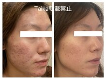 タイカ(Taika)の雰囲気（肌質改善ケアが得意なサロン☆肌悩み別メニュー多数ご用意♪）