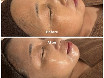 サロンアルーナ(Salon a Luna)/剥離しないハーブピーリング