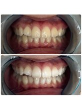 グリッター ショウナン(glitter. SHONAN)/藤沢ホワイトニングbefore/after