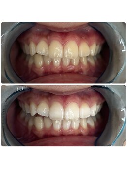 グリッター ショウナン(glitter. SHONAN)/藤沢ホワイトニングbefore/after