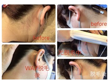 シェービング アンド エステ ローズマリー(Rosemary)/ワックス脱毛&光脱毛