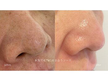 マイ フェア レディ(MY FAIR LADY)/本気で毛穴に向き合うコース