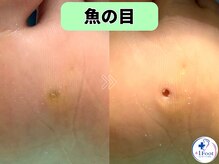 プラスワンフット 本厚木(+1 Foot)/タコ・魚の目ケア！痛みから解放