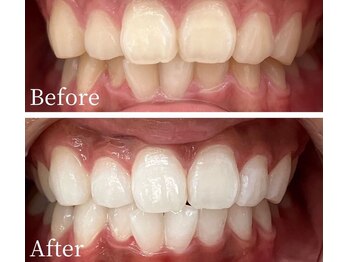 ウルル(Ululu)/ホワイトニング