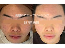 ライフサロン 別府(Life Salon)/ハーブピーリング