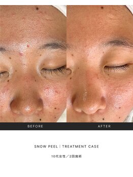 ノイ(noi.)/リジュランピール(snow peel)