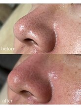 スプレミア(spuremia)/毛穴洗浄