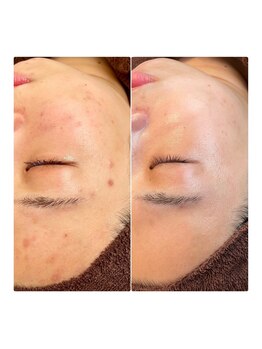 サロンドジョリー/ハーブピーリング/LAESSE