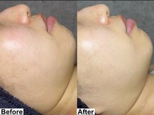 アンドミー 大阪梅田店(&me)/ララピール【艶/美白/くすみ】