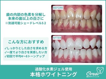 クレア(Crea)/【ホワイトニング症例写真】