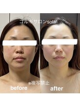 ソラ(sola*)/ダル重顔、施術1回での変化！