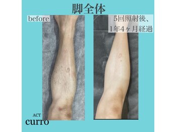 アクト クロ(ACT curro)/【脚全体】脱毛施術例