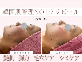 Cスキンケアクリニック 麻布店/ララピールBeforeAfter#くすみ
