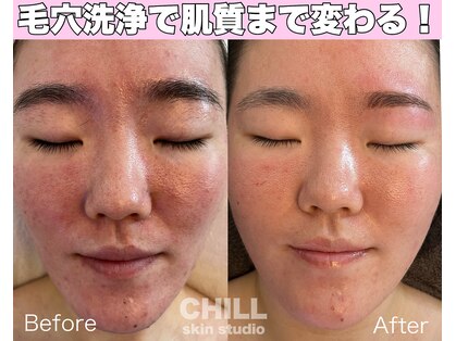 チル スキンスタジオ(CHILL skin studio)の写真