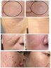 韓国最新美容医療級のスピキュールダイヤモンド＋独自ハンドケア　¥20,600⇒