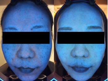 ツツイ/肌診断機