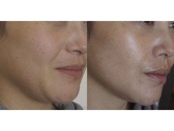 ザ シー タイムレスビューティ(THE SHE)/40代お客様症例写真