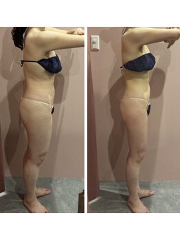 キュール(KuhL)/痩身ビフォーアフター☆