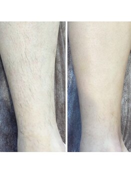 アウラ(AURA)/4回でかなりスッキリ♪