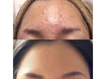 シャイネル(SHYNELL)/ハーブリプロ3回のお写真です！